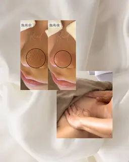 毛穴エクストラクションフェイシャル+デコルテマッサージ