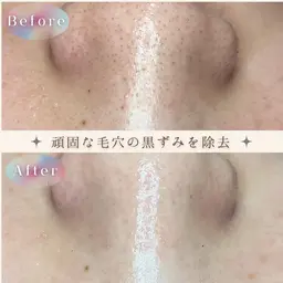 即効果実感❣️【頑固な黒ずみ・角質角栓に⭐️】最新浮かせる毛穴洗浄フェイシャル70分コース