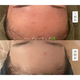 [結果重視✨] Reviハーブ2g➕オプション1種💎(デコルテ付)60分