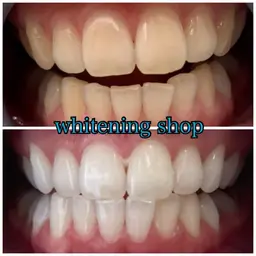 《最強垢抜けセット💗》たっぷり60分照射美白セルフホワイトニング＋耳つぼジュエリー