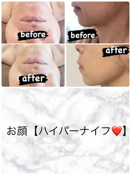 速攻小顔に💪【ハイパーナイフ顔】メイクしたままOK！仕事帰りに！デート前に✨化粧直し可😊✨