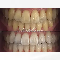 𝟔𝟔%off【モニター募集】 秋美容キャンペーン🍂°̥【白さ効果★★★★★｜白さ効果最大】ホワイトニング50分照射