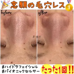 ニキビケア/化粧崩れ卒業🙆‍♀️✨ソフトピーリング毛穴洗浄+ホワイトクリアパック¥5,500