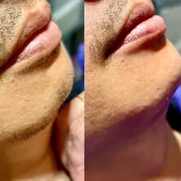 【光り輝くツヤ肌✨】メンズフェイシャルワックス（全顔）👩✨古い角質や産毛を除去してツルスベお肌に🫧