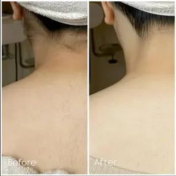 ドレスラインシェービング💍