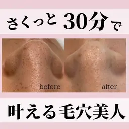 《9/6～9/30まで限定✨》現金払い限定💰気になるパーツだけの小鼻すっきりエステ
