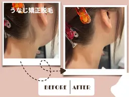 【１２月限定◇SNSで話題】＼うなじ矯正脱毛／￥6,160→￥３,９６０