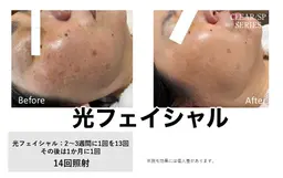 光フェイシャル