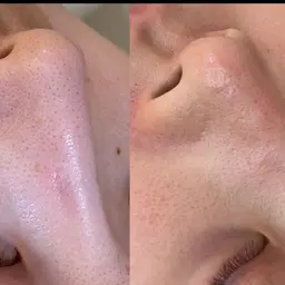 【フェイスワックス】鼻の黒ずみやお肌のざらつき、産毛が気になる方に🌟脱毛で消えない産毛や目に見えない白い毛も徹底除去！