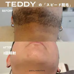 \初回限定/　さらば青髭!!徹底的に顔脱毛🫧