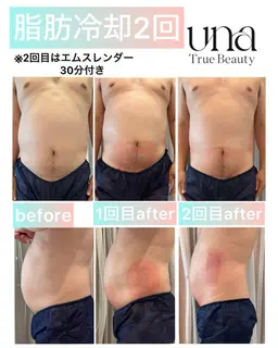 脂肪冷凍お腹4カップ✖️エムスレンダー（電磁波痩身マシン）でお腹超スッキリ！