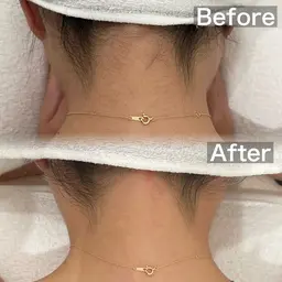 夏こそ❣️うなじwax✨医療脱毛では取ってくれない所までお好みの形に綺麗スッキリ❣️