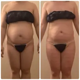 キャビ×ラジオ波×吸引トリプルマシンで爆痩せ♥️✨徹底ボディーメイク🦋90分