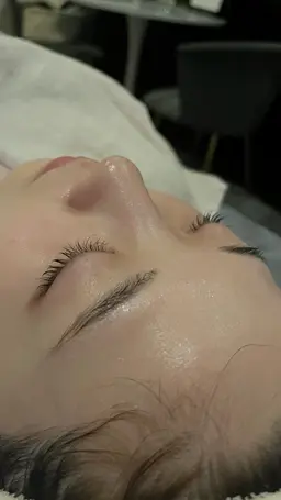 フェイシャル脂肪吸収後インディバ