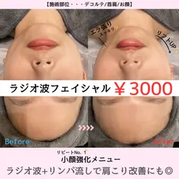 立体小顔♪ラジオ波フェイシャル💆🏼♀️リフトUP・二重アゴ他、脇肉ケアやブライダルに人気✨¥11000→¥3000