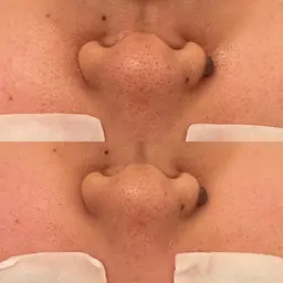 《本気の毛穴改善》ツヤ肌No.1 パーフェクトハイドラスパークコース/ 全ての毛穴トラブルに◎美容液導入マッサージ付き