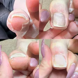 【初回カウンセリング無料】フット巻き爪補正（2ヶ所）