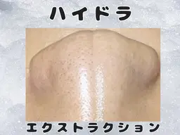 ハイドラ×毛穴エクストラクション★水光肌リフティング付き