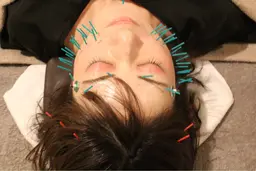 人気No.1【本数2倍📍たるみ改善】リフトアップ美容鍼　　60分