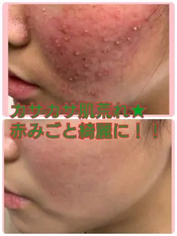 痛み有り💦DTあり‼️でも実感🩷ノーマルハーブピーリング&ハイドラ毛穴洗浄🌿しつこいトラブルにお困りの方