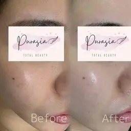 ⭐12月末まで35%OFF⭐水光ハーブピーリング×美肌LED照射×幹細胞マスク⭐ニキビや毛穴やくすみ改善⭐