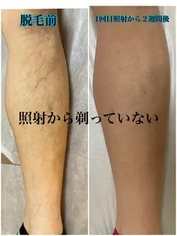 【19日限定✨️】短パンの季節に強い💪\早い者勝ちクーポン/ 💗スポーツ男子に大人気💗ひじ下➕ひざ下メンズ脱毛🚹