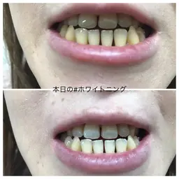 新規🦷歯のホワイトニング🦷