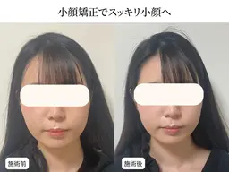 【エラ張り・むくみ改善】小顔整体＋4D小顔矯正＋姿勢矯正　12000円→