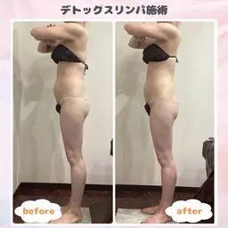 【ストレス太りにも◎】全身デトックスリンパ&最新ラジオ波×1回✨深部温活×デトックスリンパでスッキリボディへ💪🏻