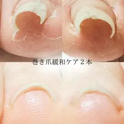 巻き爪緩和ケア<2本>🎁ご新規様ホームケアセットプレゼント🎁
