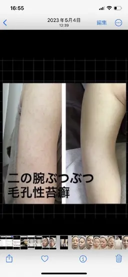 二の腕　ぶつぶつ　剥離あり　ハイドラ＋水光肌ハーブピーリング