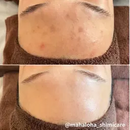 ニキビ＆ニキビ跡フォト＋美容鍼