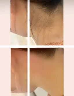 男女人気！うなじ脱毛