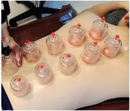 【疲労回復 時短メンテ】血行促進カッピング