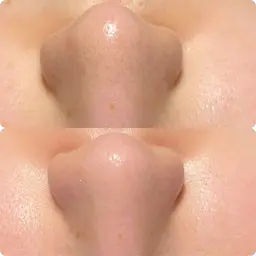 ⭐️毛穴エクストラクションのモデル募集⭐️