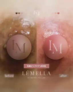 《ルメラ🥣》乳輪.脇.肘.膝.唇.お尻 ¥39000~インスタ予約のみ@milimili.lemella