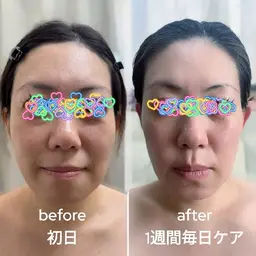 【小顔補正/頭皮マッサージ/バブルパック】ヒト幹細胞!浮腫みたるみ改善90分