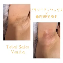 夏に向けて 両脇 ダブル脱毛🤍ブラジリアンワックス+最新光脱毛🧡