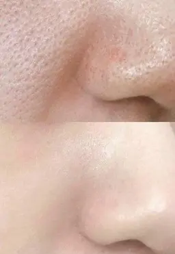 ⭐️ノーズ鼻の黒ずみサヨナラWax⭐️