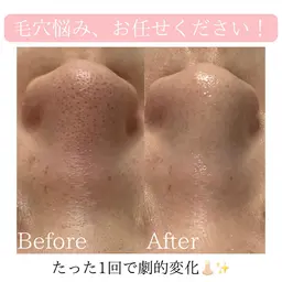 【10/27〜29まで限定❗️】毛穴洗浄+美容液導入+毛穴レスパックで即実感👃🏻✨《詰まり・黒ずみ・開き毛穴に◎》