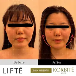 【before&afterモデル】小顔コルギ&頭蓋骨矯正&肩首・肩甲骨オイルリンパ
