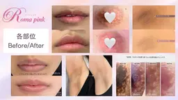 【Iラインの黒ずみケア】ローマピンクで自信が持てる美肌へ✨