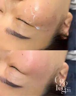 その場で取れる★韓国式最新シミ・ホクロ・イボケアモニター様募集!5spotまで