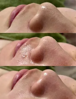 溶ける角栓【毛穴吸引】 引き締めパック＆鎮静パック付き🥸フルフェイス全顔毛穴サッパリ ¥6980