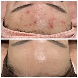 ハーブピーリング期間限定お得なクーポン♪