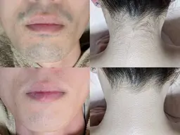 【男女】毛穴レス部分脱毛（お顔/腕脇/胸腹/背中/VIO/脚）産毛や濃い毛に効果抜群◎