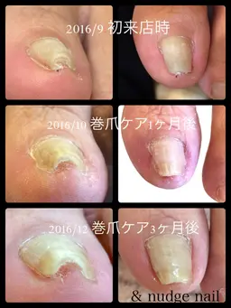 巻き爪ケア1本