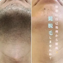 【男性】圧倒的脱毛効果で自己処理卒業!人気No.1ヒゲ脱毛🫧