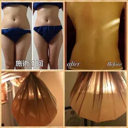 痩せ効果NO.1🥇【スペシャル】筋膜リリースインド+高周波+腸マッサージ+足つぼリフレ🔥大量発汗🔥120分