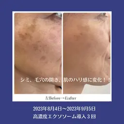 再生系美容液導入で年齢肌に集中アプローチ◎ツヤ肌フェイシャル（高濃度プレミアム美容液使用）